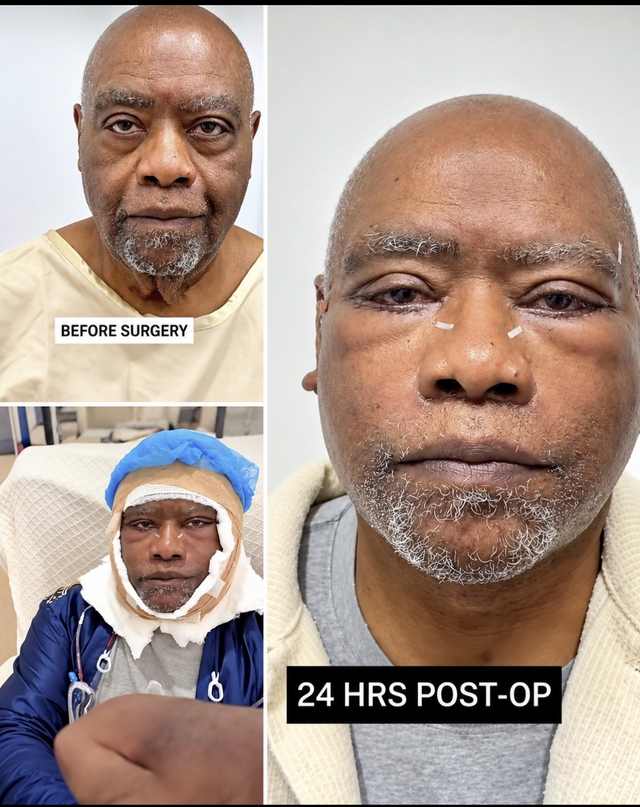 Before surgery, bandaged after the operation, and 24 hours after: an older man's face during facelift recovery